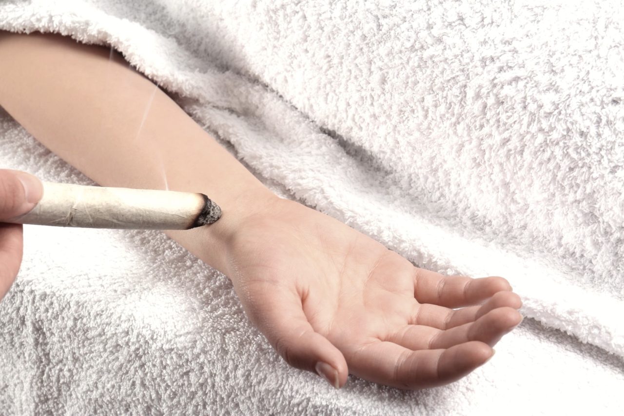 Moxibustion-moxa therapie